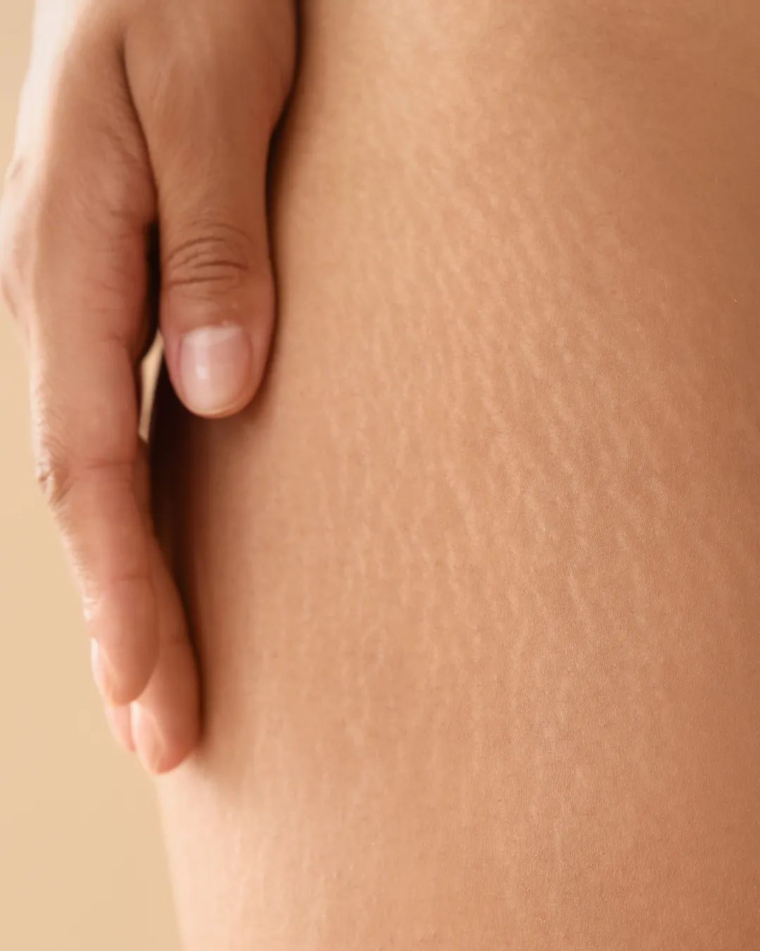 Tratamento para Estrias - Tratamento dermatológico para regeneração e melhora da textura da pele